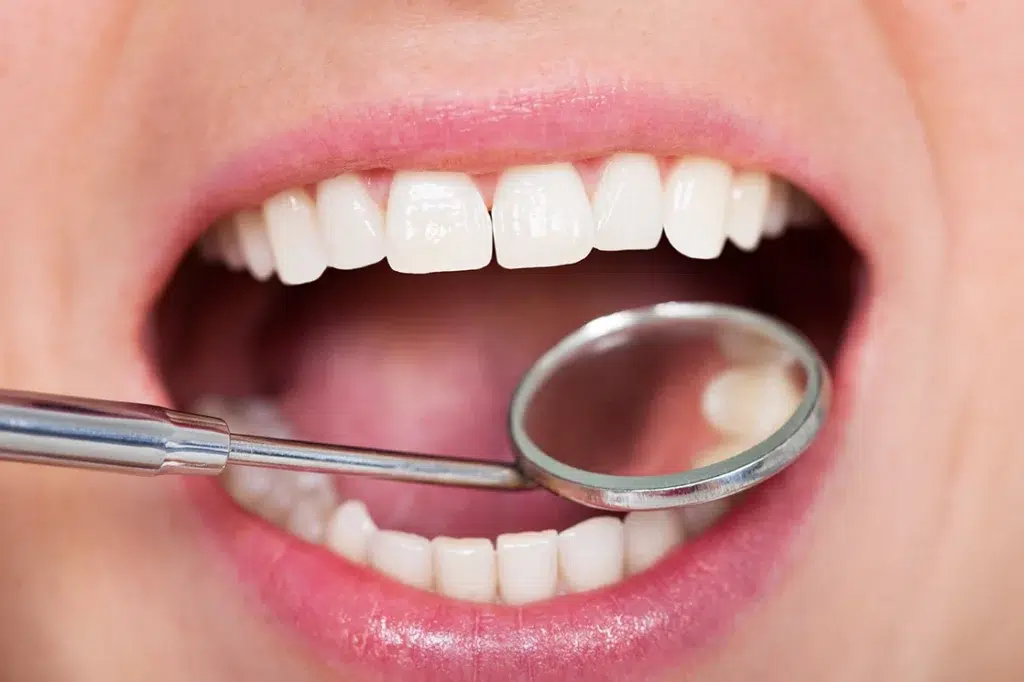 White teeth being examined for a dental filling procedure
