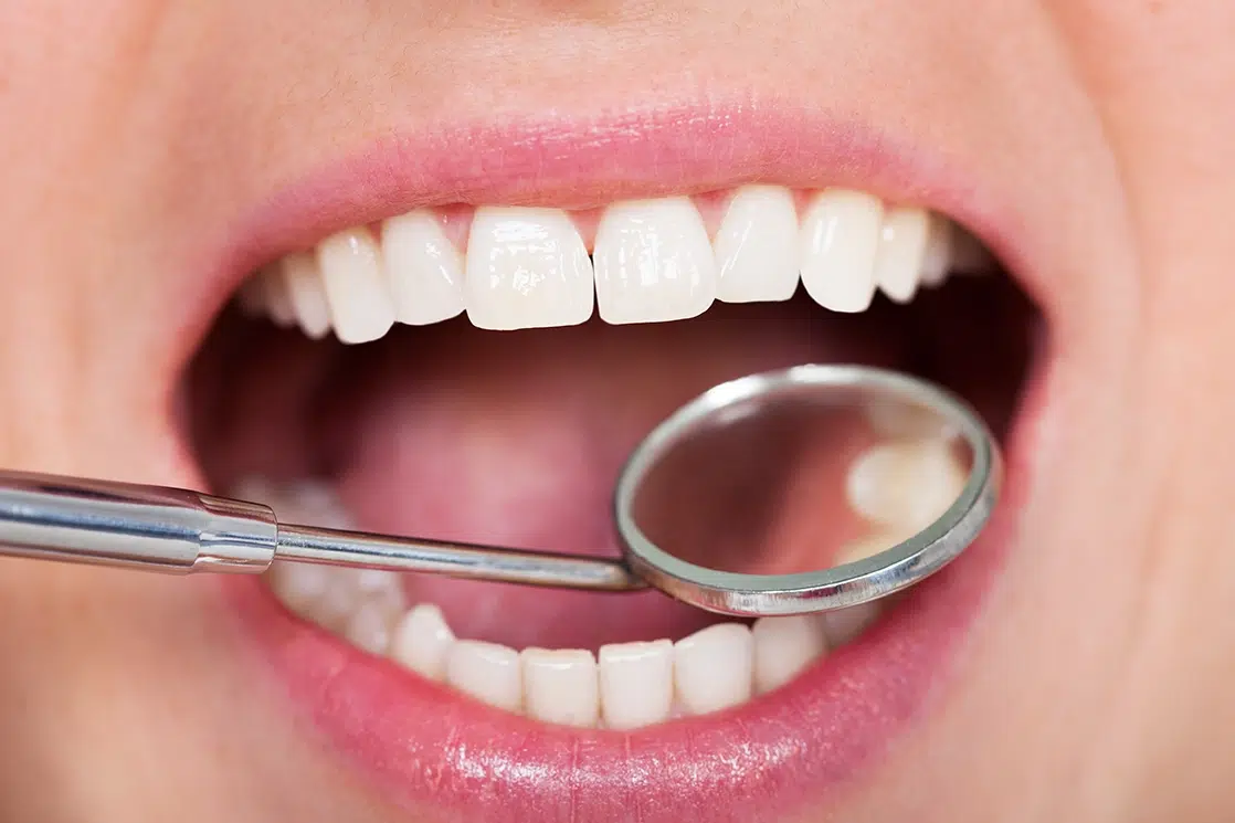 White teeth being examined for a dental filling procedure