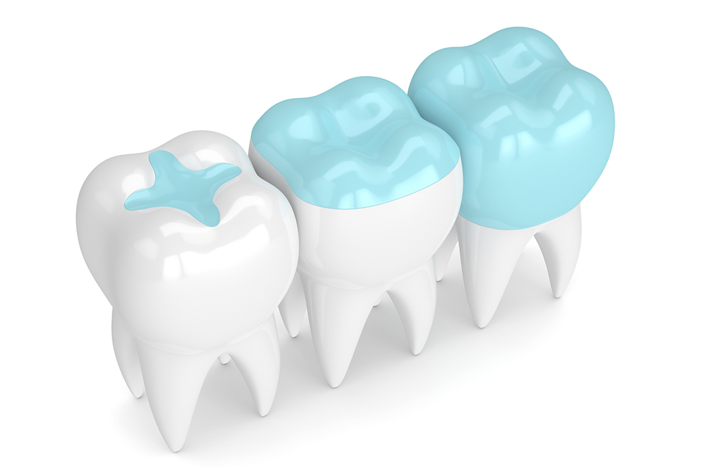 Sealants applied to teeth using blue color to show how they look