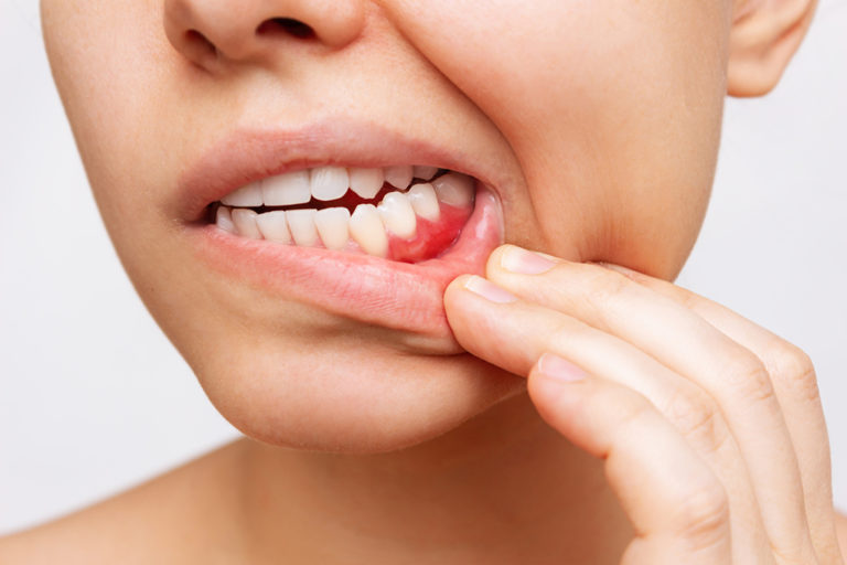 Woman with red inflamed gums resolving for healthy gums this new year