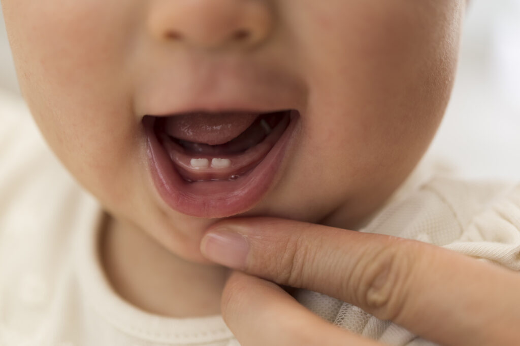 Understanding Baby Bottle Mouth