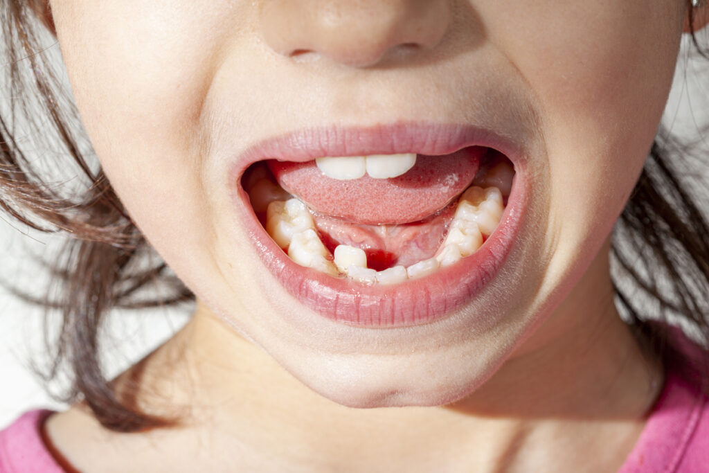 Does My Child Need Braces?