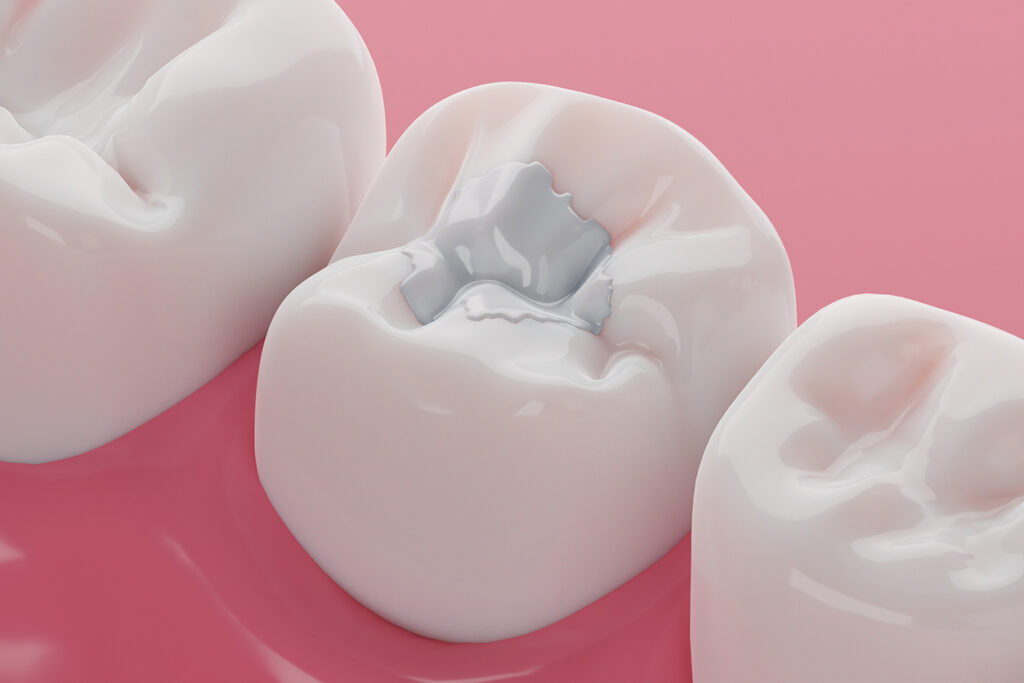 dental crown vs filling - Teeth white composite filling, Decay and broken teeth treatment concept. 3D rendering.