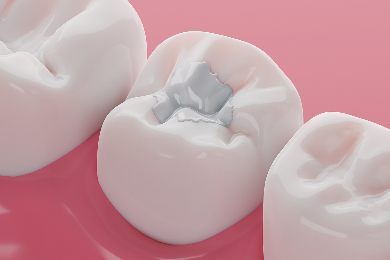 dental crown vs filling - Teeth white composite filling, Decay and broken teeth treatment concept. 3D rendering.