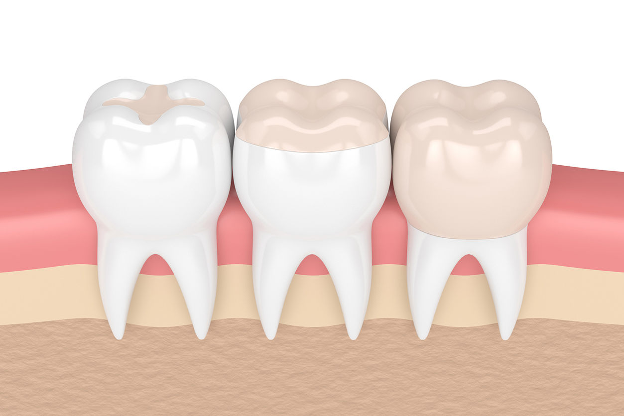 dental crown vs filling - 3d render of teeth with inlay, onlay and crown filling in gums