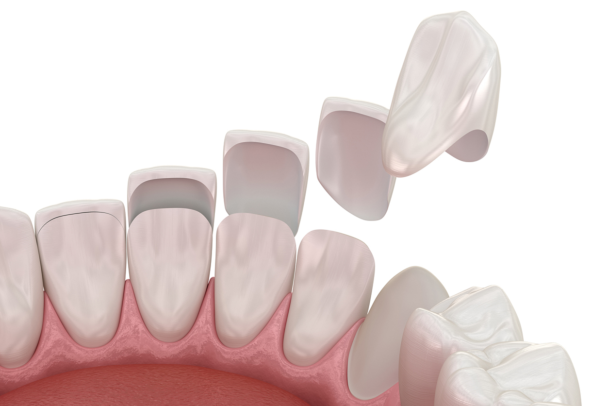 Veneers vs. Invisalign - Dental veneer placement over frontal teeth. 3D illustration