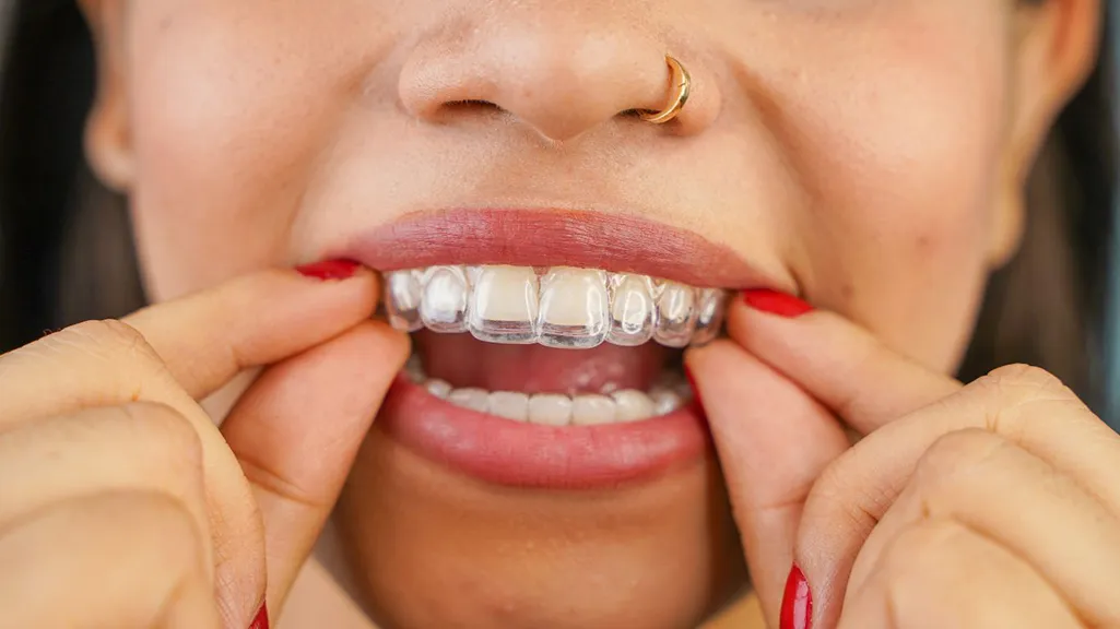 Clear dental aligner being placed over teeth